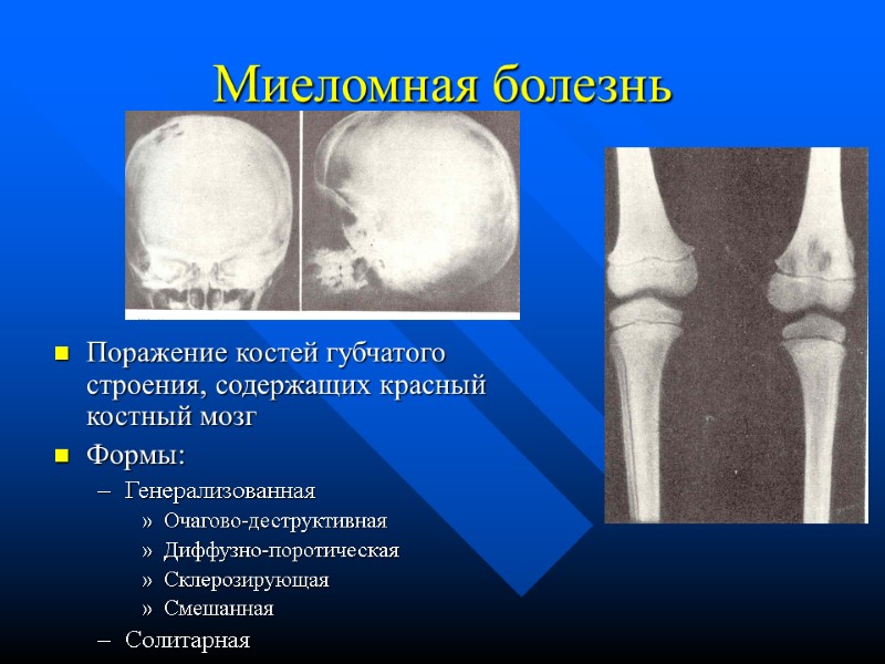 Миеломная болезнь Поражение костей губчатого строения, содержащих красный костный мозг  Формы: Генерализованная Очагово-деструктивная